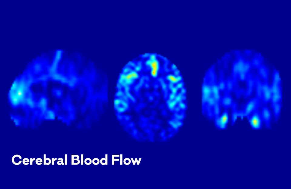 Integrity of Blood Brain Barrier